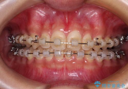 深い咬み合わせとデコボコの歯列をワイヤー矯正で改善の治療中