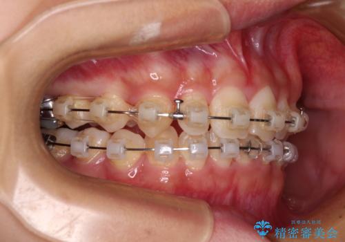 深い咬み合わせとデコボコの歯列をワイヤー矯正で改善の治療中