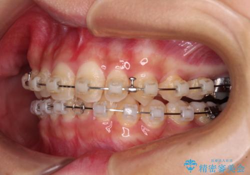 深い咬み合わせとデコボコの歯列をワイヤー矯正で改善の治療中