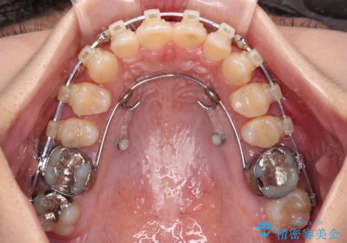 深い咬み合わせとデコボコの歯列をワイヤー矯正で改善の治療中