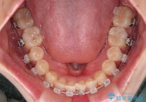 深い咬み合わせとデコボコの歯列をワイヤー矯正で改善の治療中