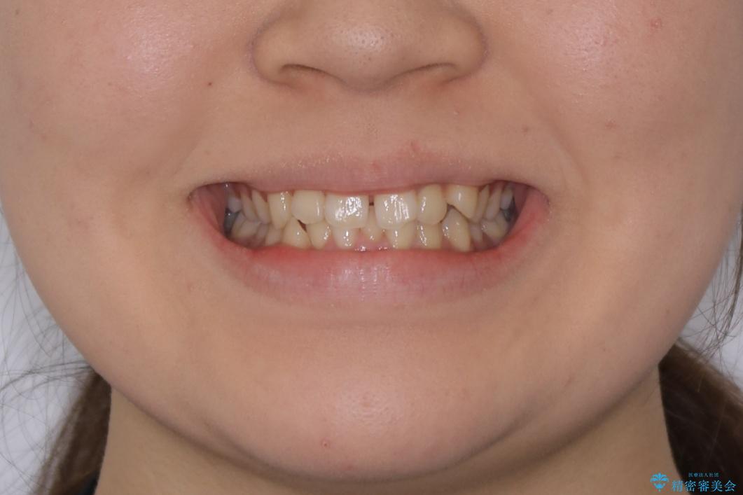 【非抜歯】すきっ歯と噛み合わせの治療の治療前（顔貌）