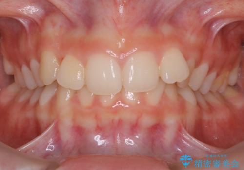 【非抜歯】前歯のガタつきを改善　笑顔の印象も変わる!の症例 治療前