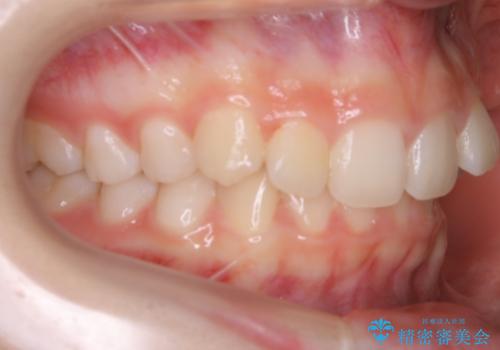 【非抜歯】前歯のガタつきを改善　笑顔の印象も変わる!の治療前