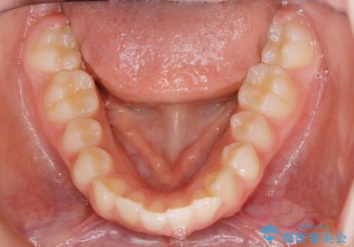 【非抜歯】前歯のガタつきを改善　笑顔の印象も変わる!の治療前