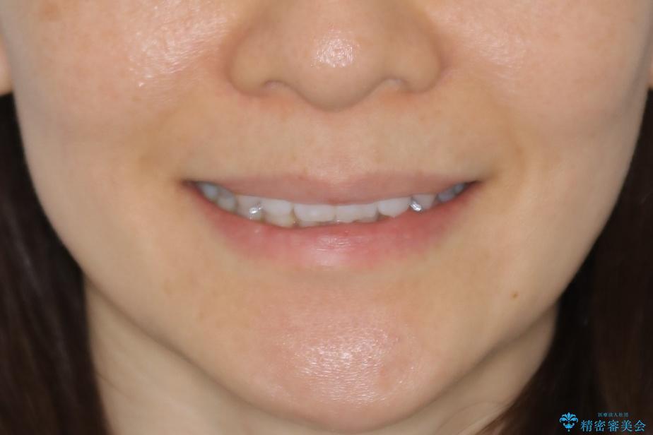 【抜歯】矯正治療とインプラントで正常な噛み合わせを実現の治療後（顔貌）