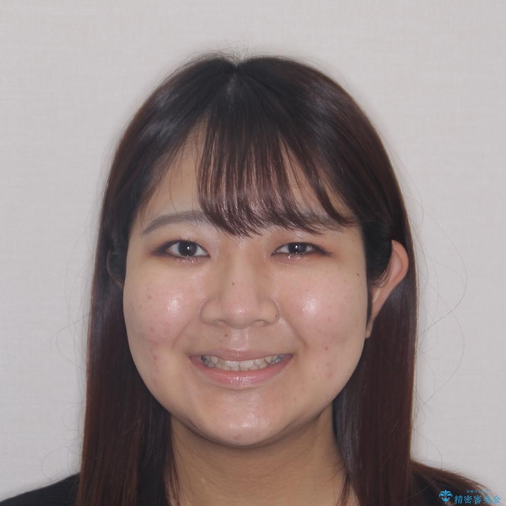 【モニター】舌のトレーニングを行いながら後戻りの再矯正の治療前(顔貌)