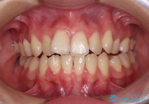 【モニター】舌のトレーニングを行いながら後戻りの再矯正の症例 治療前