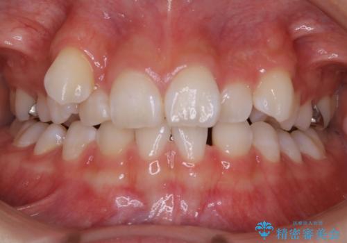 【抜歯】歯の先天欠如　歯の本数が上下で違う場合の治療の症例 治療前