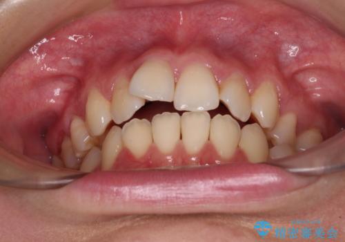 【モニター】舌のトレーニングを行いながら後戻りの再矯正の治療前