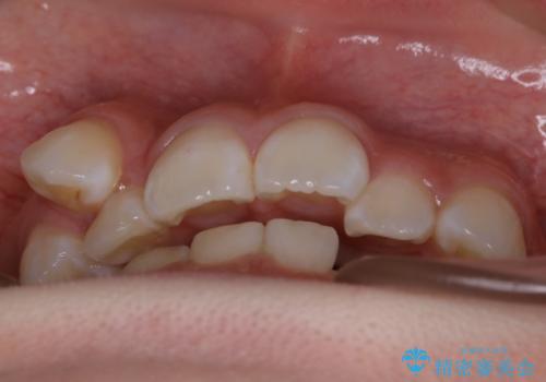 【抜歯】歯の先天欠如 歯の本数が上下で違う場合の治療の治療前