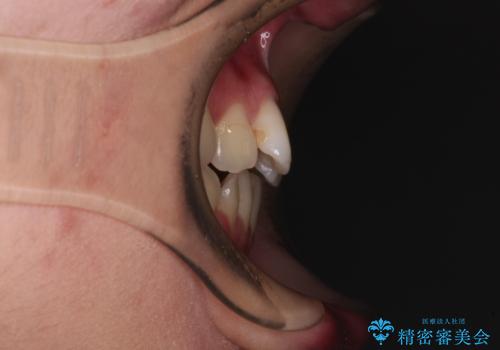 【モニター】舌のトレーニングを行いながら後戻りの再矯正の治療前