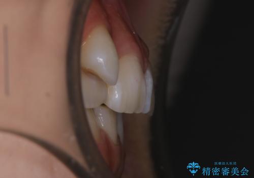 【抜歯】歯の先天欠如 歯の本数が上下で違う場合の治療の治療前