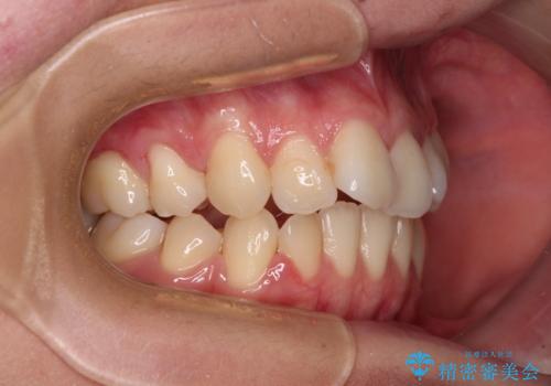 【モニター】舌のトレーニングを行いながら後戻りの再矯正の治療前