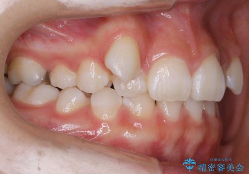 【抜歯】歯の先天欠如 歯の本数が上下で違う場合の治療の治療前