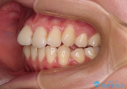 【モニター】舌のトレーニングを行いながら後戻りの再矯正の治療前