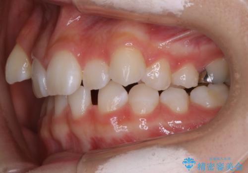 【抜歯】歯の先天欠如　歯の本数が上下で違う場合の治療の治療前
