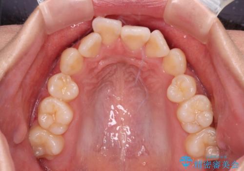 【モニター】舌のトレーニングを行いながら後戻りの再矯正の治療前