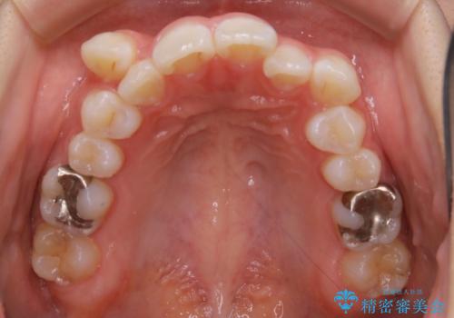 【抜歯】歯の先天欠如 歯の本数が上下で違う場合の治療の治療前