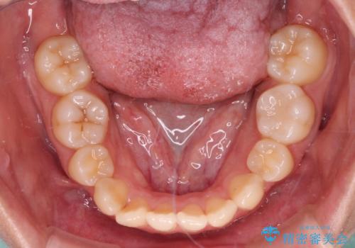 【モニター】舌のトレーニングを行いながら後戻りの再矯正の治療前
