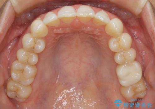 【抜歯】矯正治療とインプラントで正常な噛み合わせを実現の治療後