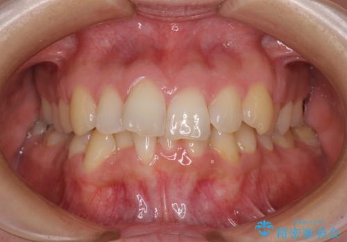 【モニター】前歯のデコボコをインビザラインで改善の症例 治療前