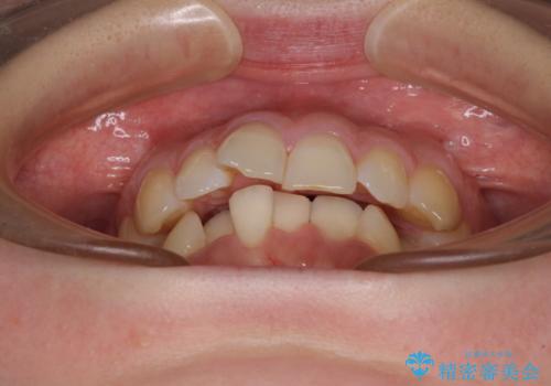 【モニター】前歯のデコボコをインビザラインで改善の治療前