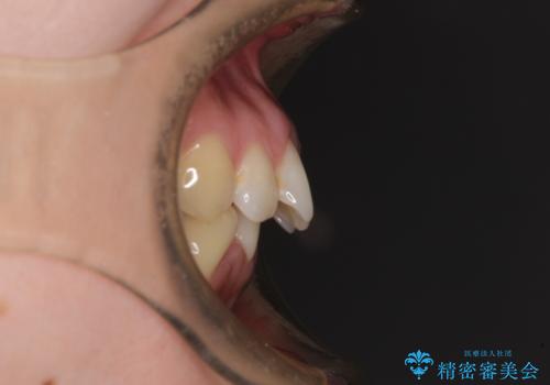 【モニター】前歯のデコボコをインビザラインで改善の治療前