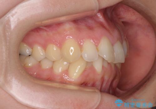 【モニター】前歯のデコボコをインビザラインで改善の治療前