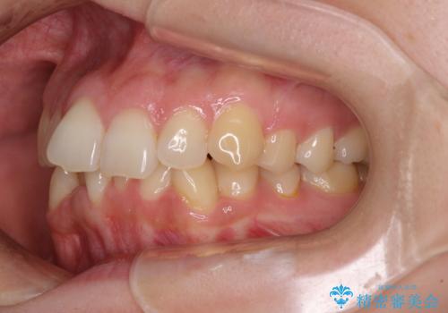 【モニター】前歯のデコボコをインビザラインで改善の治療前
