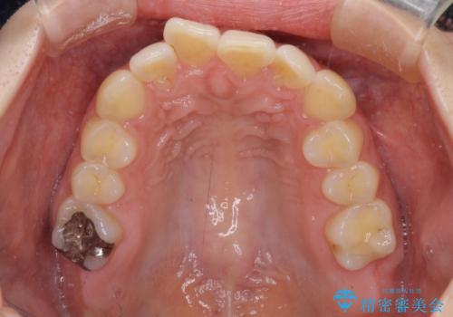 【モニター】前歯のデコボコをインビザラインで改善の治療前