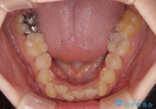 【モニター】前歯のデコボコをインビザラインで改善の治療前