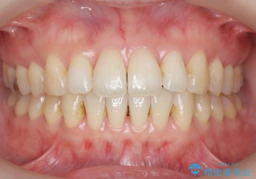 マウスピースで治す、出っ歯の矯正治療の治療後