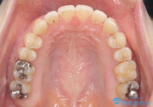 マウスピースで治す、出っ歯の矯正治療の治療後