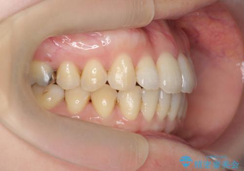 マウスピースで治す、出っ歯の矯正治療の症例 治療後