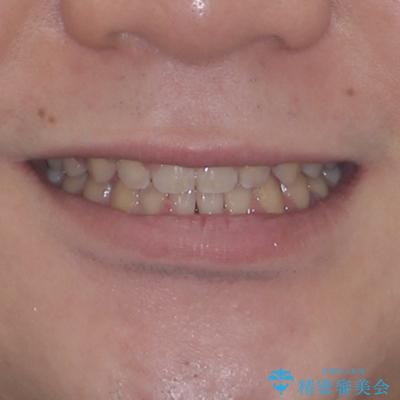 空隙歯列を閉じる 舌のトレーニングとワイヤー矯正の治療後(顔貌)