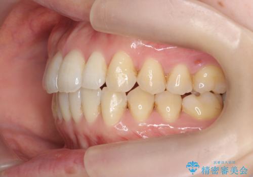 マウスピースで治す、出っ歯の矯正治療の治療後