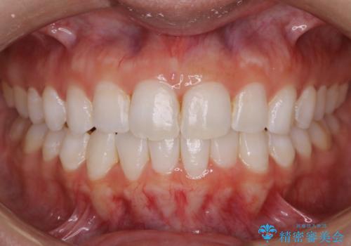 【非抜歯】歯軸を治して正しい噛み合わせへの症例 治療後