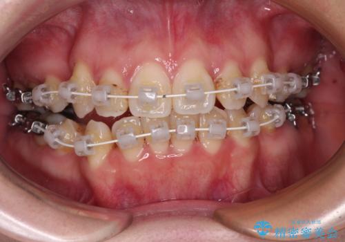 インビザラインが続けられない　装置変更して抜歯矯正の治療中