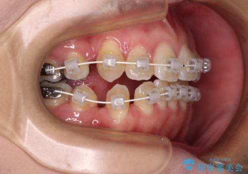 インビザラインが続けられない　装置変更して抜歯矯正の治療中