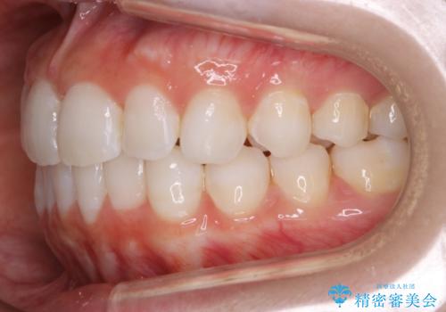 【非抜歯】歯軸を治して正しい噛み合わせへの治療後