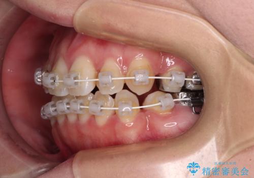 インビザラインが続けられない 装置変更して抜歯矯正の治療中