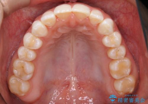【非抜歯】歯軸を治して正しい噛み合わせへの治療後