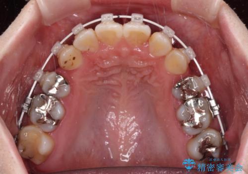 インビザラインが続けられない 装置変更して抜歯矯正の治療中