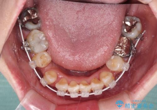 インビザラインが続けられない 装置変更して抜歯矯正の治療中