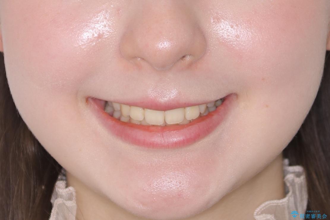 【非抜歯】前歯のガタつきを改善　笑顔の印象も変わる!の治療後（顔貌）