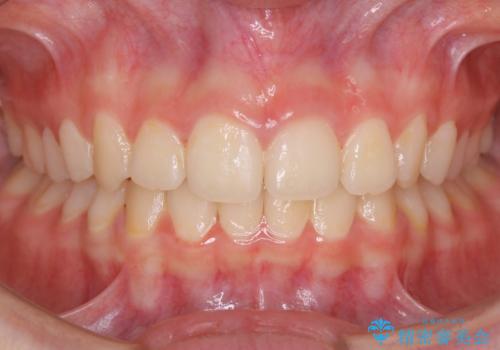 【非抜歯】前歯のガタつきを改善　笑顔の印象も変わる!の症例 治療後