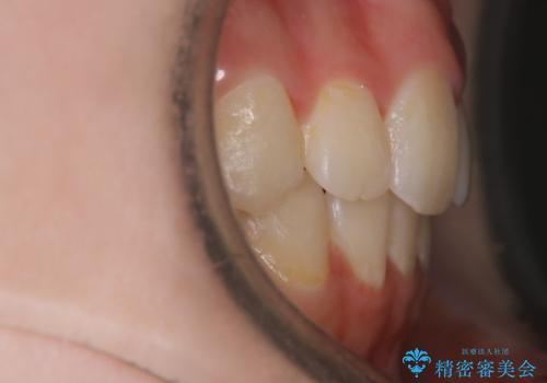 【非抜歯】前歯のガタつきを改善　笑顔の印象も変わる!の治療後