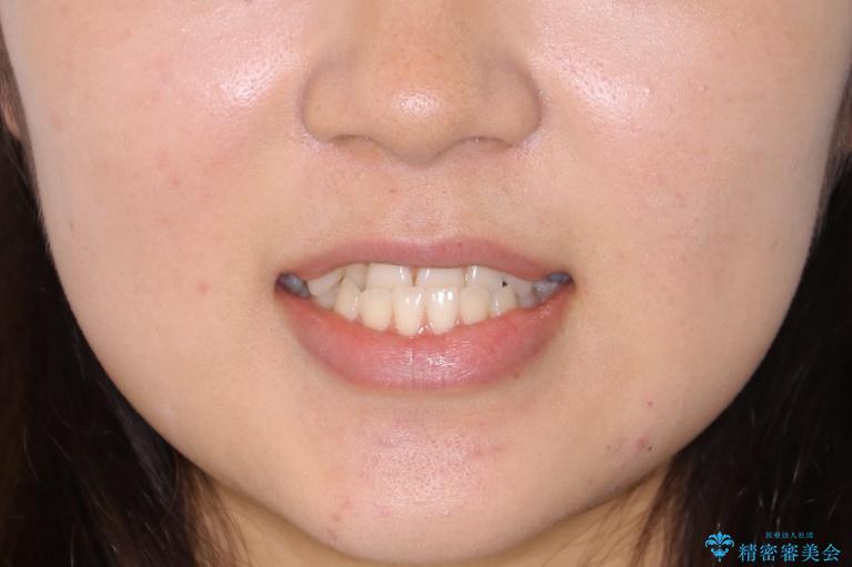 【非抜歯】受け口の改善　10代で始める本格的噛み合わせ治療の治療前（顔貌）