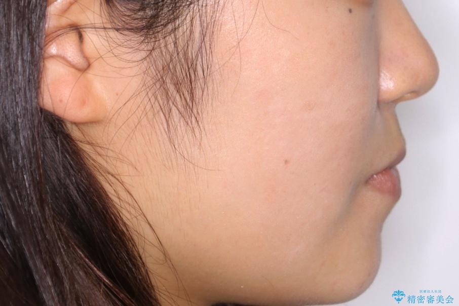 【非抜歯】受け口の改善 10代で始める本格的噛み合わせ治療の治療前(顔貌)